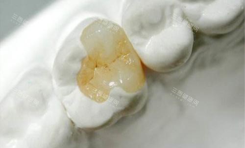 補牙後牙痛點解？拆解常見原因同處理方法