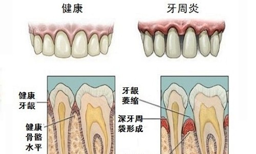 深圳做水激光牙周炎價錢是多少？基礎治療區間再800~8000+病情重度程度、治療範圍影響價格