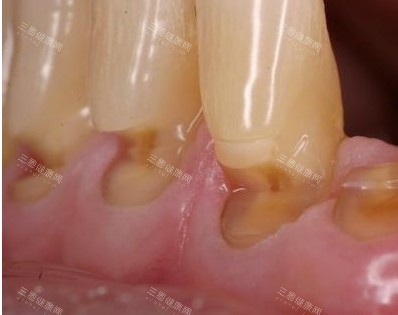 牙龈萎缩照片