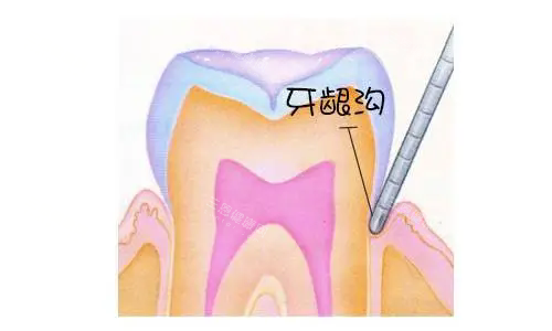 牙龈沟示意图.webp