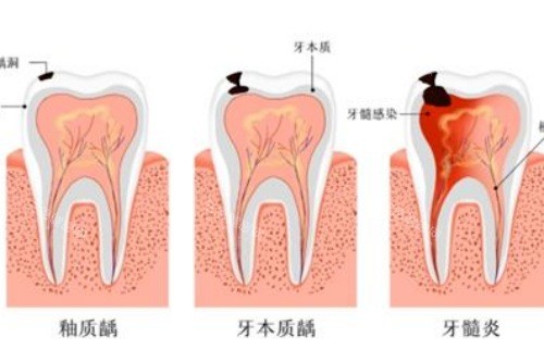 牙髓炎會唔會自己好？牙髓炎到底有冇機會自愈？
