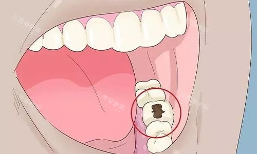 牙齿坏了