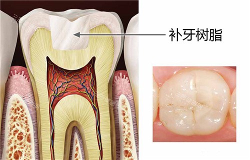 香港人必睇！珠海補牙一隻幾錢？收費詳情同材料大解構！