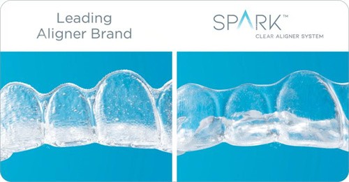 Spark精靓隐形矫正器通透度更高