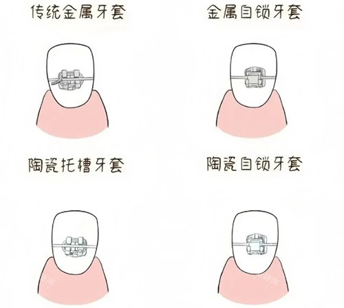 做牙套前必睇！從檢查到佩戴全流程價錢解析，避免被診所多收冤枉錢！