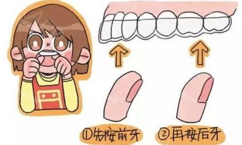 隐形牙套佩戴示意图