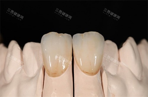 牙橋價錢差喺邊？金屬、全瓷、烤瓷牙橋優缺點對比，睇完再決定！
