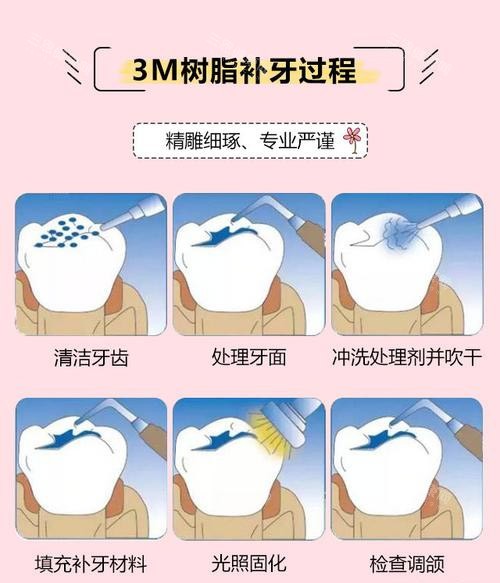門牙補牙幾錢？樹脂、瓷貼面價格對比，邊種更啱你嘅牙齒情況？