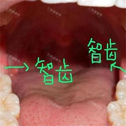 牙齿智齿所在位置