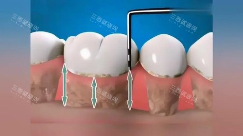 牙周病治療要幾耐？香港牙醫拆解：輕症4週vs重症半年！附$8000-3萬收費參考