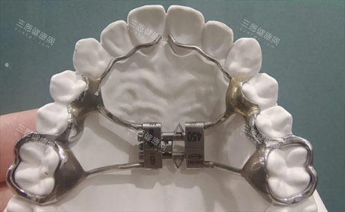 记忆簧固定扩弓器