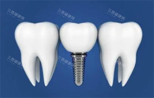 諾貝爾種植體值唔值得？港人實測：技術硬、質保長、例子多！