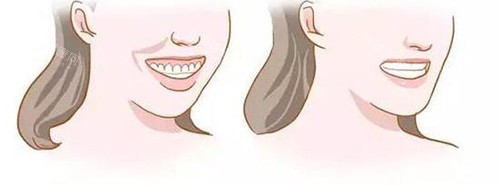 牙齿矫正脸型变化对比漫画图