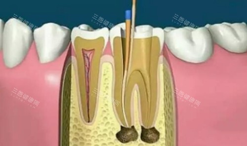 根管治療後能用多久？香港牙醫親授延長壽命的5大保養秘訣！