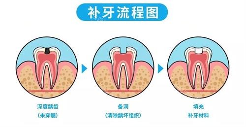 樹脂補牙vs陶瓷貼面：香港牙齒修復技術優劣解析（附真人實例）！