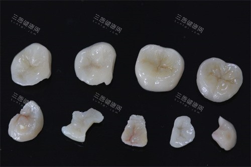牙齒嵌體和做牙冠有什麼區別？分享兩者特點/維持時間/收費！