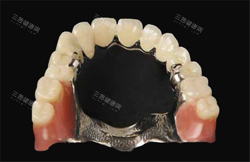 種植牙VS活動假牙：從舒適度、使用壽命同咀嚼功能三大方面分析
