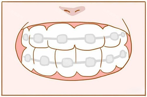 香港箍牙價錢大比拼：Invisalign 隱適美 vs Angelalign 時代天使，邊款更夾你荷包？