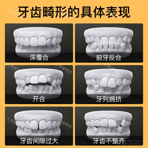 牙齿畸形形式