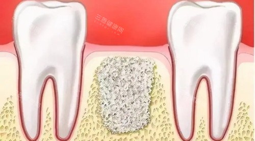 骨粉示意图