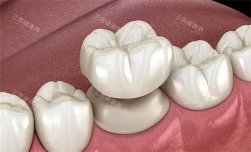 國產全瓷牙有哪些品牌？哪個品牌好？對比愛爾創/美加/瓷倍健/愛迪特/格萊美等品牌