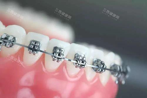 牙齿矫正牙套金属托槽矫正