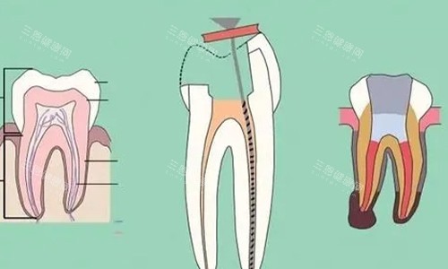 根管治疗的步骤示意
