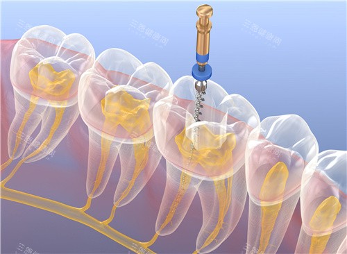 根管治疗透视图