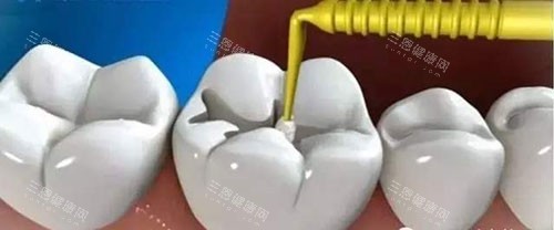 补牙治疗过程示意图