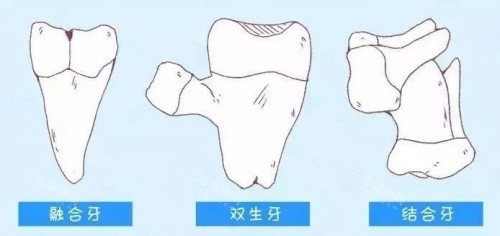 贅生齒手術費用大概幾多？兒童多生牙手術費用一般係200-5000元左右