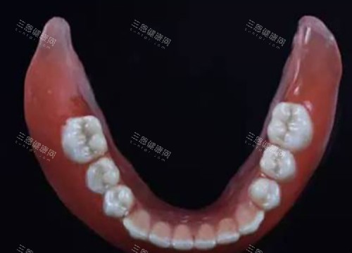 吸附性全口义齿 吸附性全口义齿