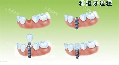 深圳愛芽康口腔醫院價格表2025，種植牙3200元起/牙齒矯正8900元起/全瓷牙780元起