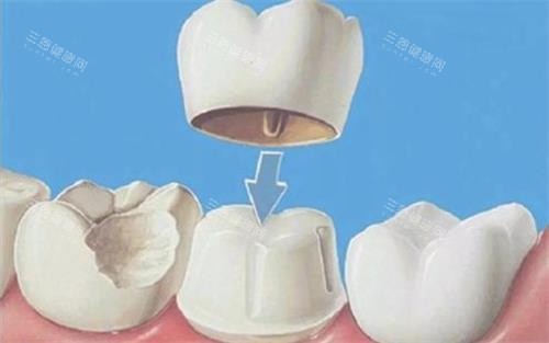 2025全瓷牙品牌排名前十及價格分享：快來看看哪款全瓷牙更適合你