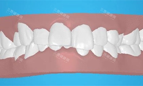 深圳斯美奧口腔牙齿深覆合卡通图