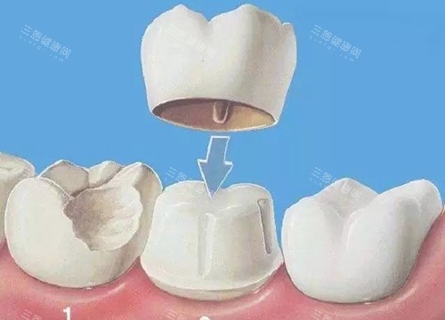 火熱盤點！種植牙牙冠品牌排行榜：內含國產/進口牙冠品牌及價格一覽！