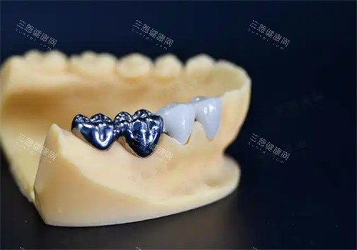 纯钛一体冠牙齿
