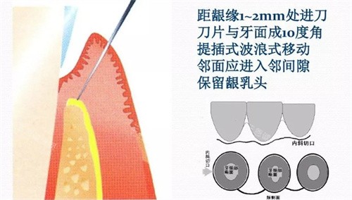 牙周炎翻瓣手术全切口