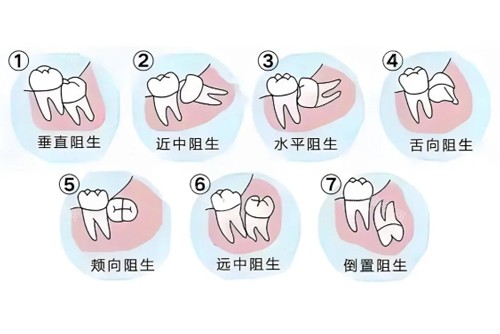 智齿难度系数图