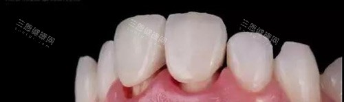 香港假牙舒适度大比拼：活動牙托 vs 種植牙固定假牙，哪個更適合長者？