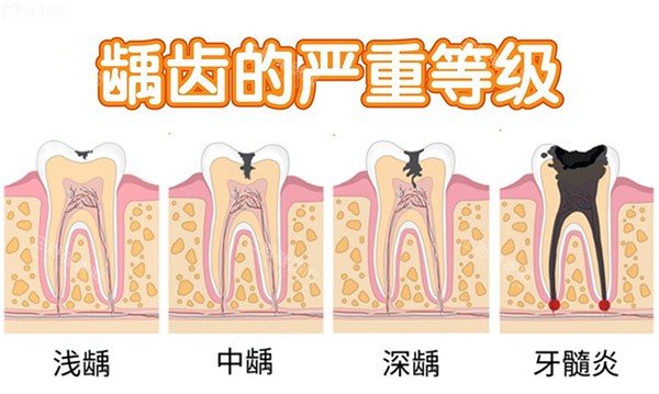 香港杜牙根必讀：顯微根管搶救頑固牙痛 為何八成人捱過才知遲？