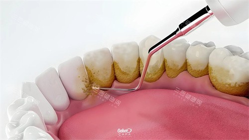 牙石同牙垢究竟有咩唔同？一文带你了解两者区别同埋正确嘅口腔清洁方法