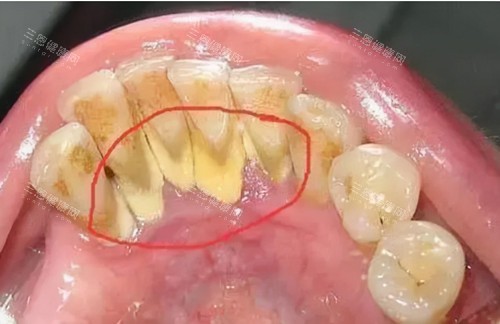 牙结石实拍图片