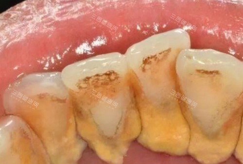 牙结石的照片