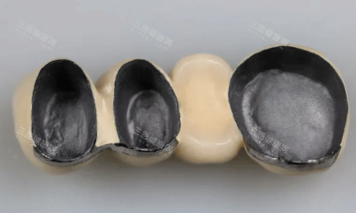 全瓷连桥冠照片
