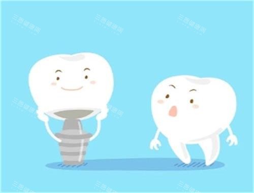 美國3i種植體怎麽樣？：品質、設計、舒適度等方面全方面解析！