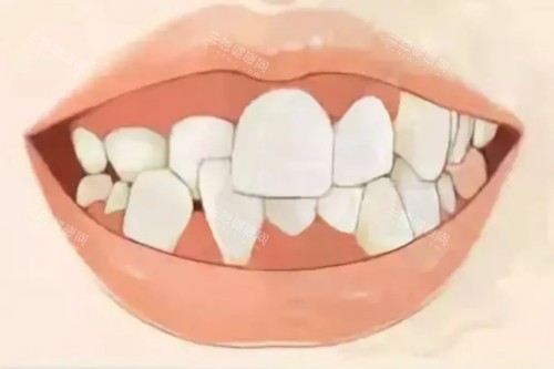 牙齿畸形卡通模型图