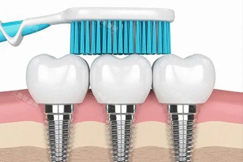 韓國種植體質量靠譜嗎？從材料、技術、臨床结果同埋價錢等解析