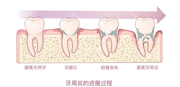 牙周炎