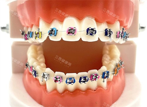 金属托槽矫正模型图片