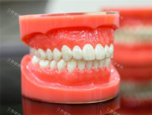 隱形牙套全港价目！Invisalign$3.5-6万vs本地品牌$2-4万